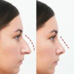 Rhinoplasty in Riyadh