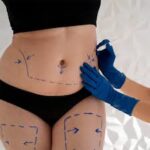 Liposuction Surgery in Dubai