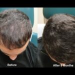 PRP Hair Treatment in Riyadh
